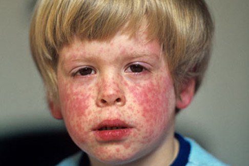 Australian boy infected in 2012