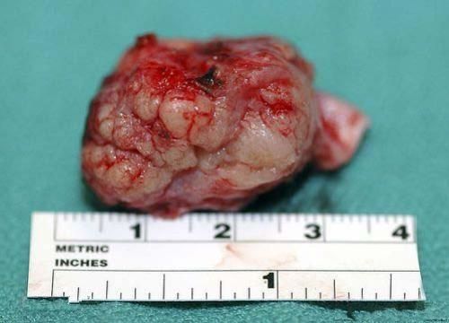 Brain Tumour