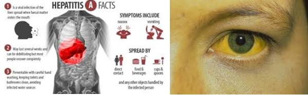 Hepatitis A Symptoms